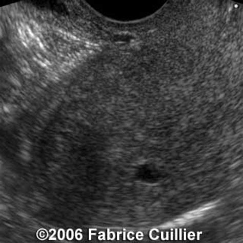 📃 Ectopic Pregnancy Cornual