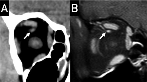 Imaging Of Superior Ophthalmic Vein A Pictorial Overview Clinical