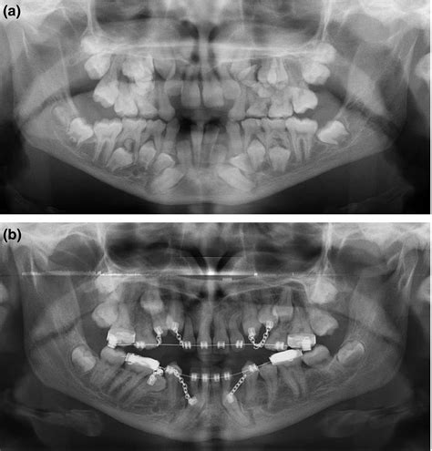 Pediatric Oral And Maxillofacial Surgery Xeneo 5