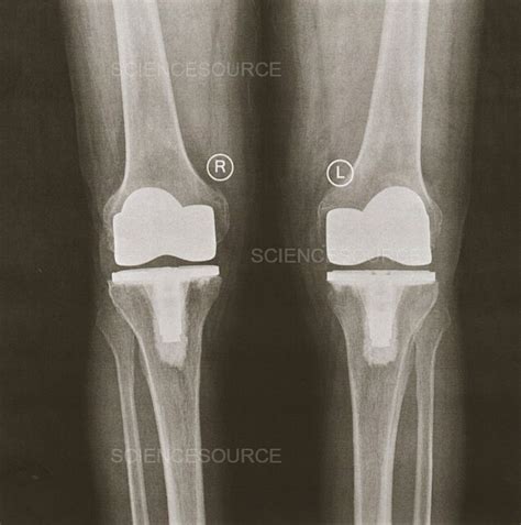 Photograph | Knees after replacement surgery, X-ray | Science Source Images