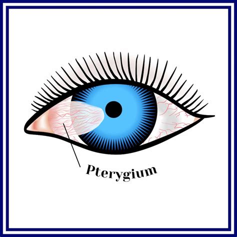 Pterygium Treatment Las Vegas | Pterygium Henderson | Nevada Eye Physicians