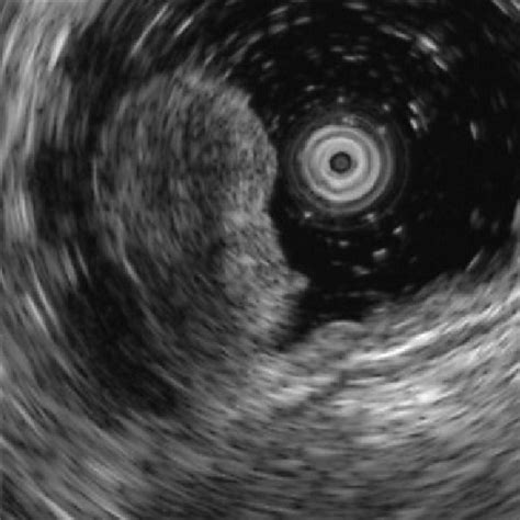 Endoscopic Ultrasonography Revealed A Homogeneous Hypoechoic Lesion Of