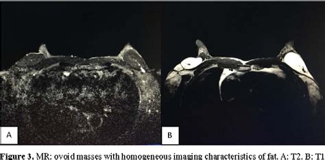 Figure 1 From An Unusual Case Of Benign Symmetric Lipomatosis