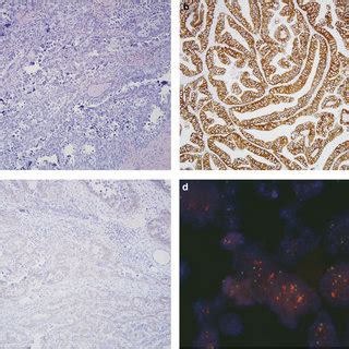 Histomorphology, HER2 protein expression and HER2 gene amplification in ...