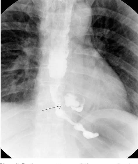 Figure From Conservative Management Of Esophageal Perforations During