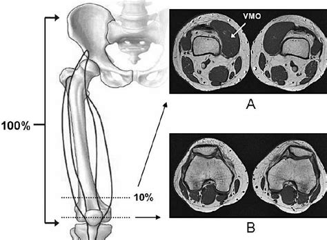 Selected Axial Magnetic Resonance Images A Vastus Medialis Obliquus Download Scientific