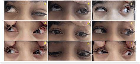 Postoperative clinical photographs of the patient showing improved ...