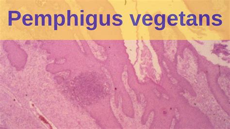 Pemphigus Vegetans Pathology Mini Tutorials Youtube