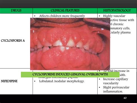 Drug Induced Gingival Enlargment Digo Ppt