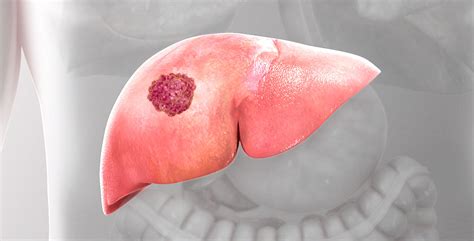 Affordable Liver Cancer Surgery At Gbl Advanced Liver Centre