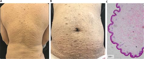 Acrochordons A Clue For Men1 Associated Acromegaly The American