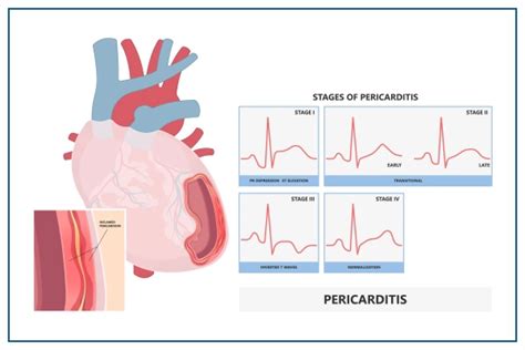 pericarditis symptoms  diagnosis prevention