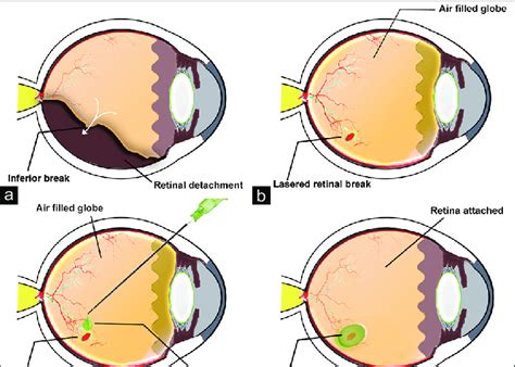 Schematic Representation Of The Surgical Technique Of Glue Assisted