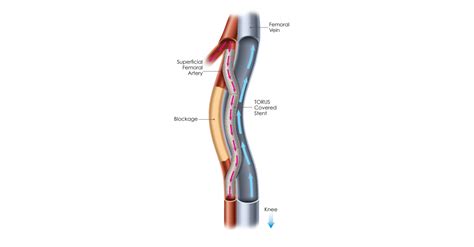 pq bypass completes enrollment  detour percutaneous femoral