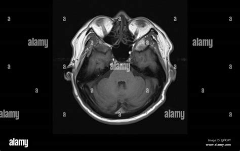 Healthy brain, MRI scan Stock Photo - Alamy