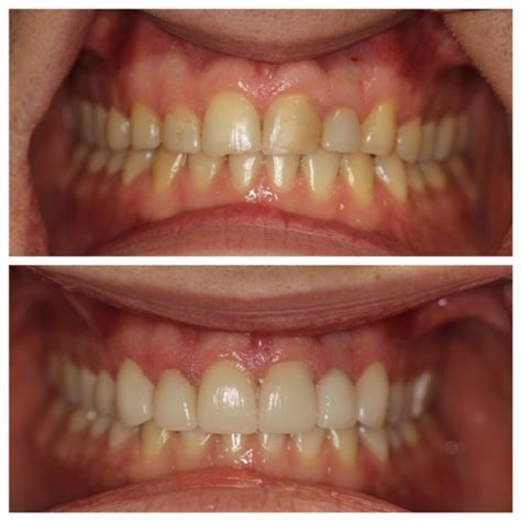 Porcelain Teeth Before And After