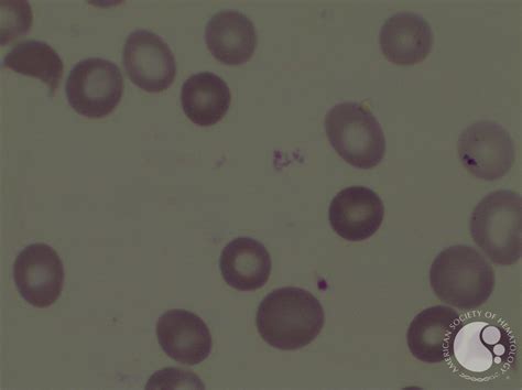 Schistocytes