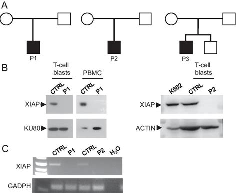 defective xiap expression   patients  clinical  features