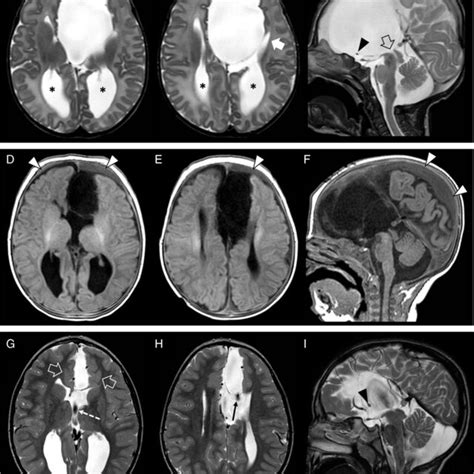 presence  malformation  cortical development  patient
