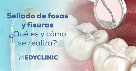 Qué es el sellado de fosas y fisuras Medyclinic