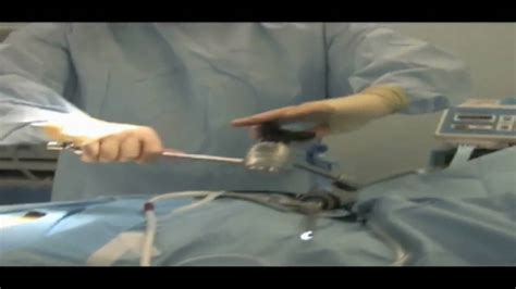 Solo Laparoscopic Supracervical Hysterectomy Lsh With The Viky® Robot