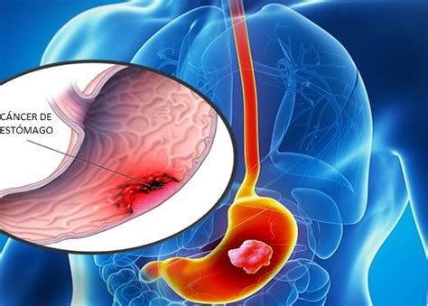 Cancer Gastrico Causas Sintomas Y Tratamiento Cancerwalls