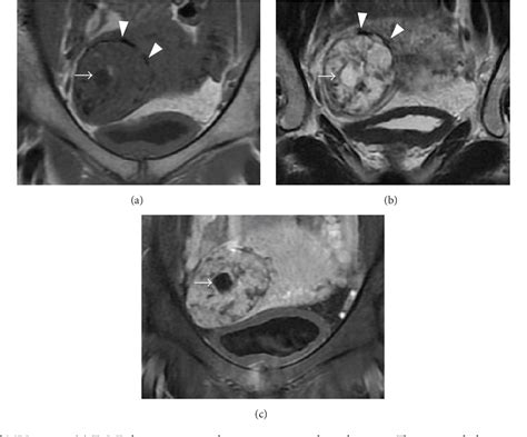 [pdf] Ectopic Molar Pregnancy Diagnostic Efficacy Of Magnetic