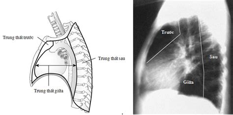 U Trung Thất Sau Bài giảng CĐHA