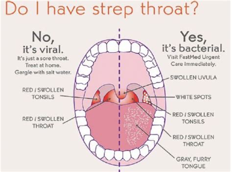 Sore Throat