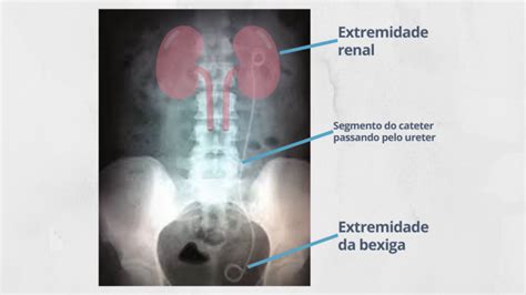 Afinal Para Que Serve O Cateter Duplo J Dr Fellype Amaral