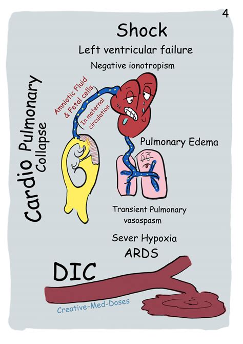 Amniotic Fluid Embolism - Creative Med Doses