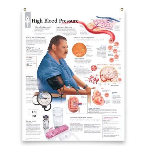 Set of 3 Laminated Medical Posters High Blood Pressure, Effects of Hyp