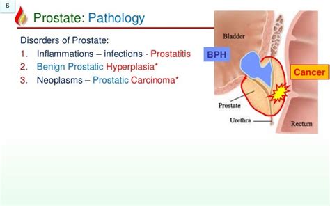 Pathology Of Prostate Benign