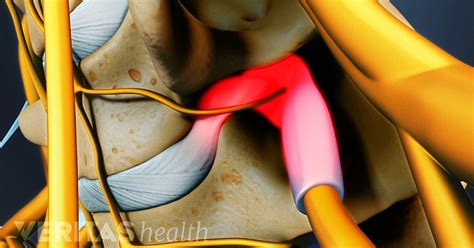 Cervical Herniated Disc Symptoms and Treatment Options