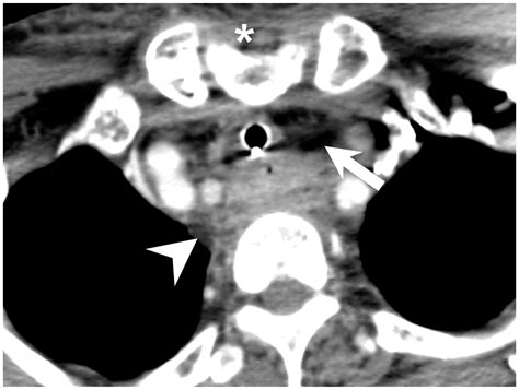 Factors Affecting The Necessity Of Tracheostomy In Patients With Deep