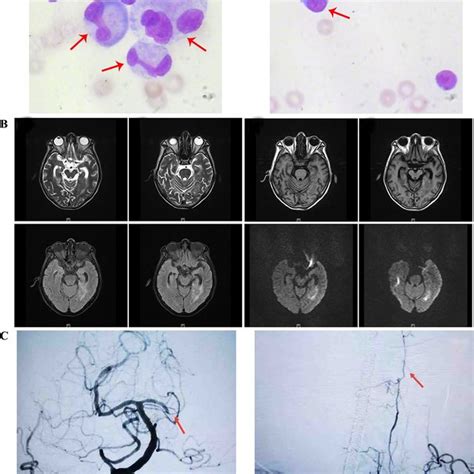 Results Of Imaging And Cerebrospinal Fluid Cytology Examinations A Download Scientific