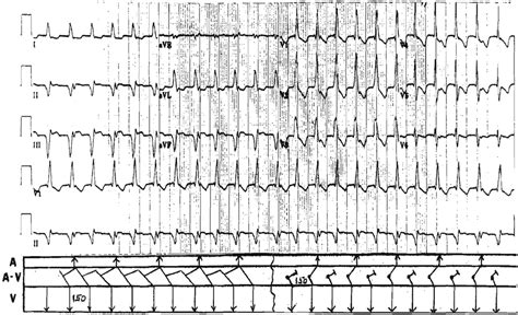 Accelerated Junctional Rhythm