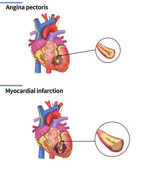 Chest Pain & Discomfort - Cadence Heart Centre