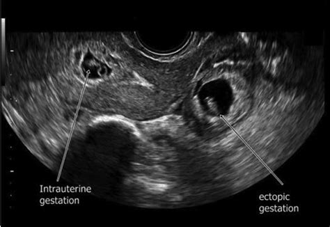 The Rising Incidence Of Heterotopic Pregnancy Current Perspectives And