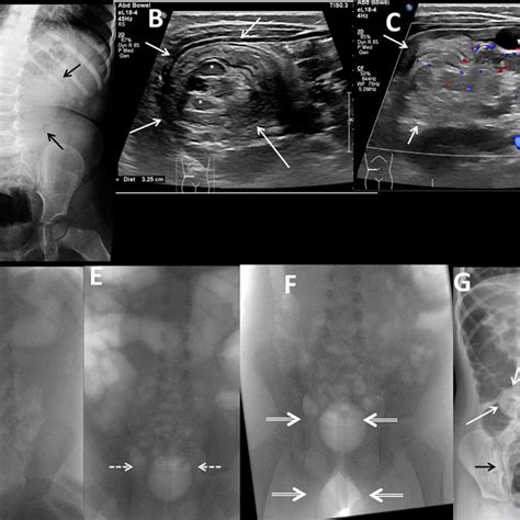 Two Year Old Female With Ileocolic Intussusception And Successful Download Scientific Diagram