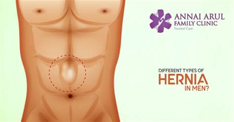 What Are The Different Types Of Hernia In Men Multispeciality