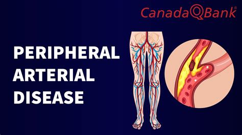 Peripheral Arterial Disease Youtube