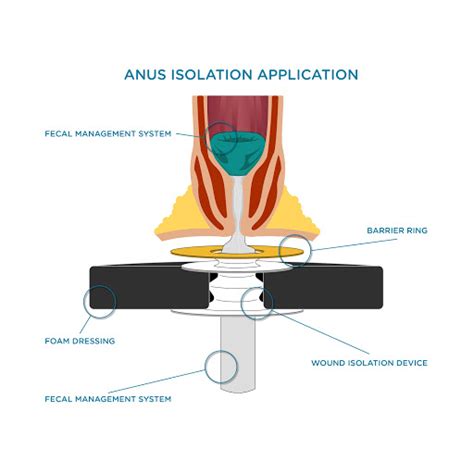 Techniques Fistula Solution