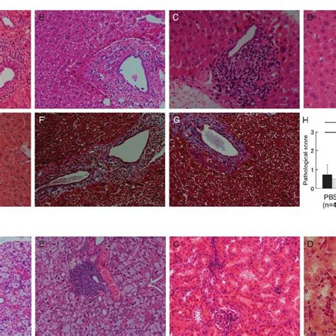 Hypothetical Pathogenesis Of Pbc The Slowly Progressing Steps By The Download Scientific