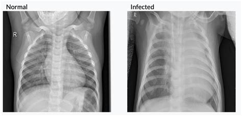 Github Jj862 Convolutional Neural Networks For Detection Of Pneumonia In Chest X Ray Images