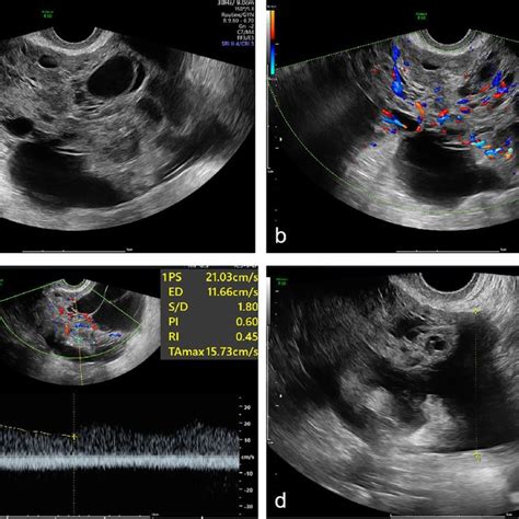 A Hypoechoic Mass Was Observed In The Right Ovary With Posterior Echo