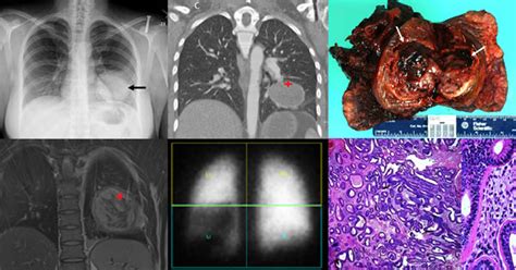 The Radiologic and Pathologic Diagnosis of Biphasic Pulmonary Blastoma