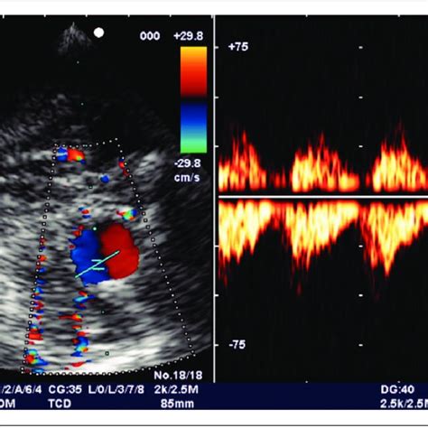 Transcranial Doppler Ultrasonography Shows A Rounded Structure In The