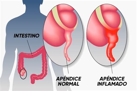 Diferencia Entre Apendicitis Y Apendicitis Aguda Kulturaupice Porn