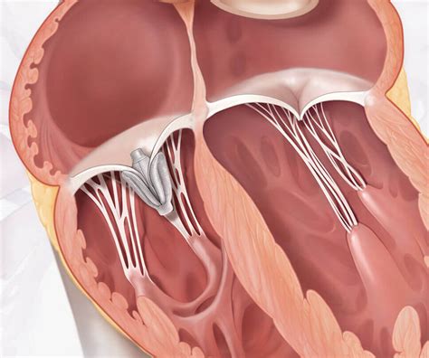 The Clasp Ii Tr Trial Edwards Lifesciences